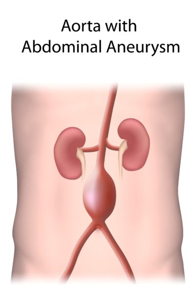 Abdominal,Aortic,Aneurysm,Vs,Normal,Aorta.